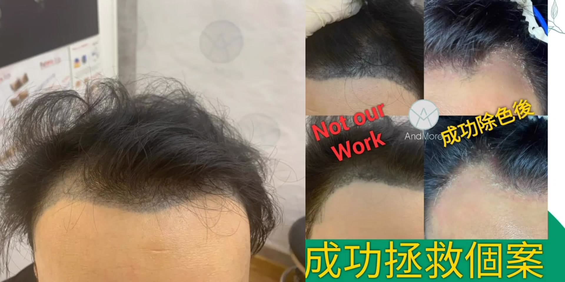 Laser拯救失敗個案