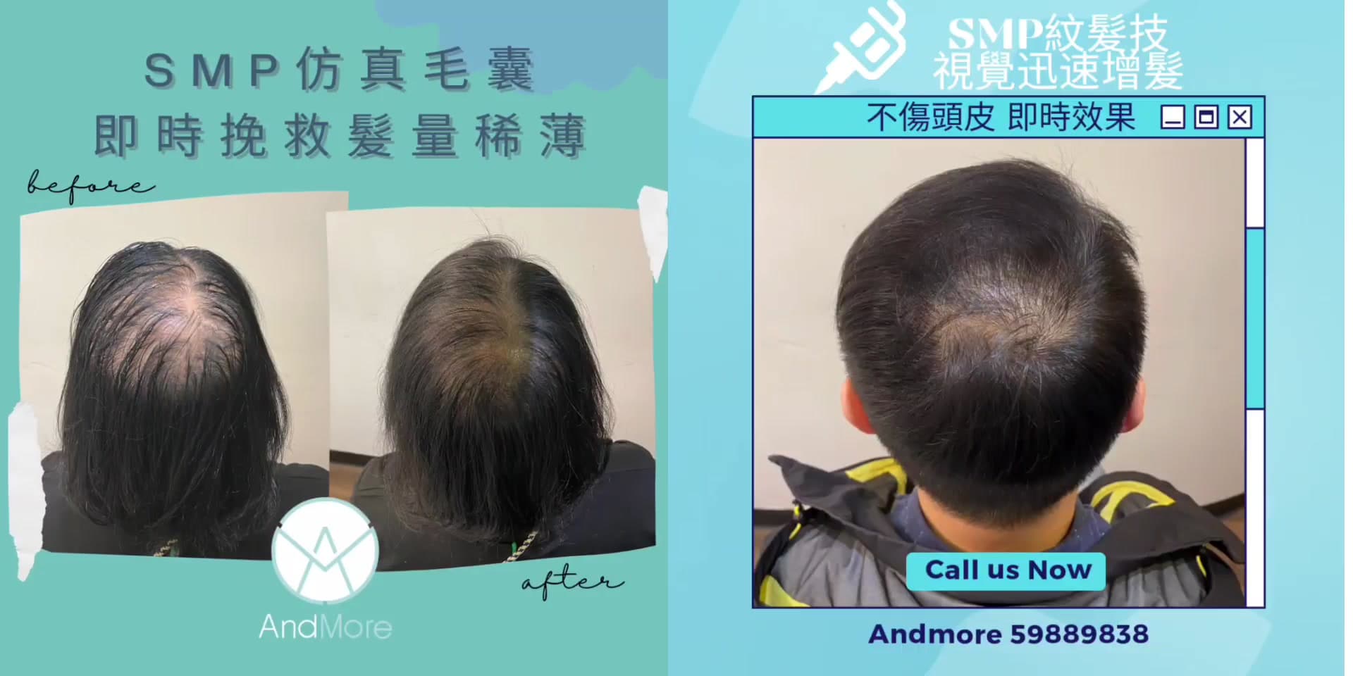 SMP仿真毛囊紋髮術